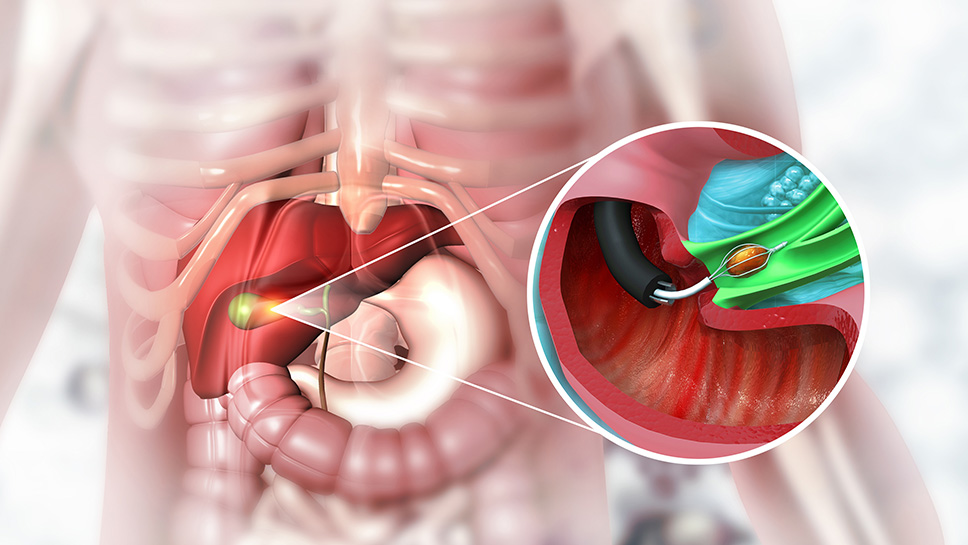 MNT) Recommended Post-Cholecystectomy