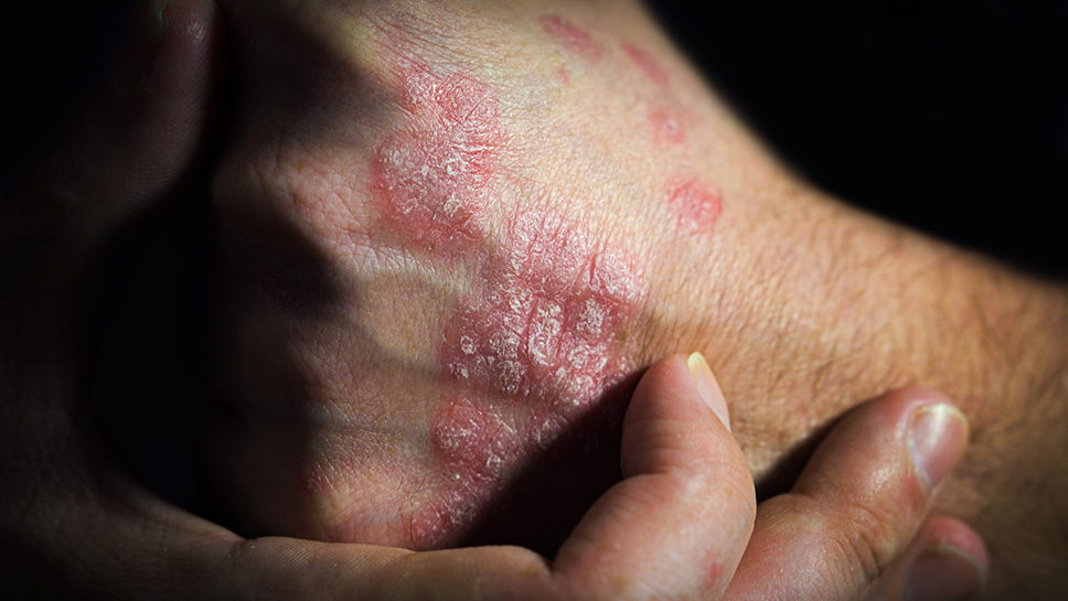 hand with psorisis