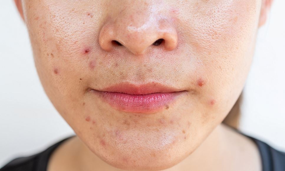 Woman with acne inflamed on her face