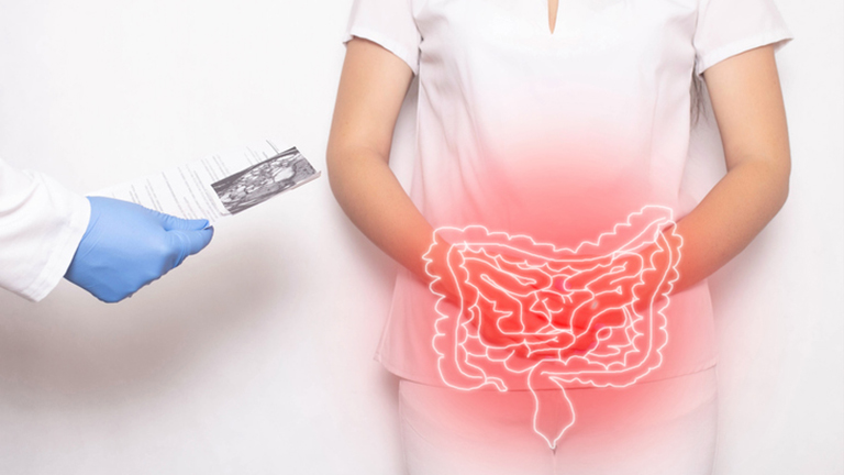  Diverticular Disease