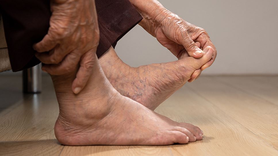 Woman with gout massages her swollen and inflamed ankles and feet.