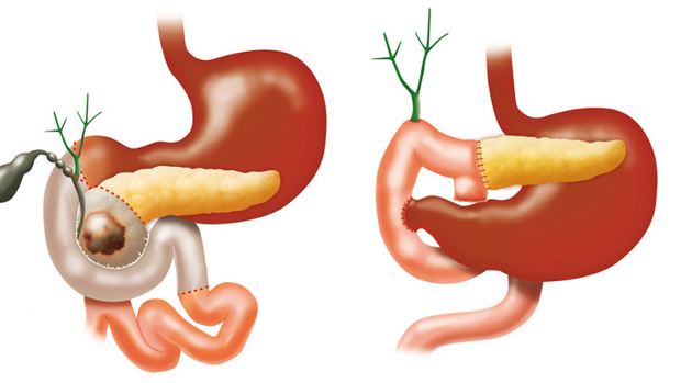 Nutrition Therapy following a Whipple Procedure