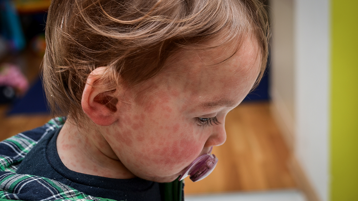 Child with measles rash