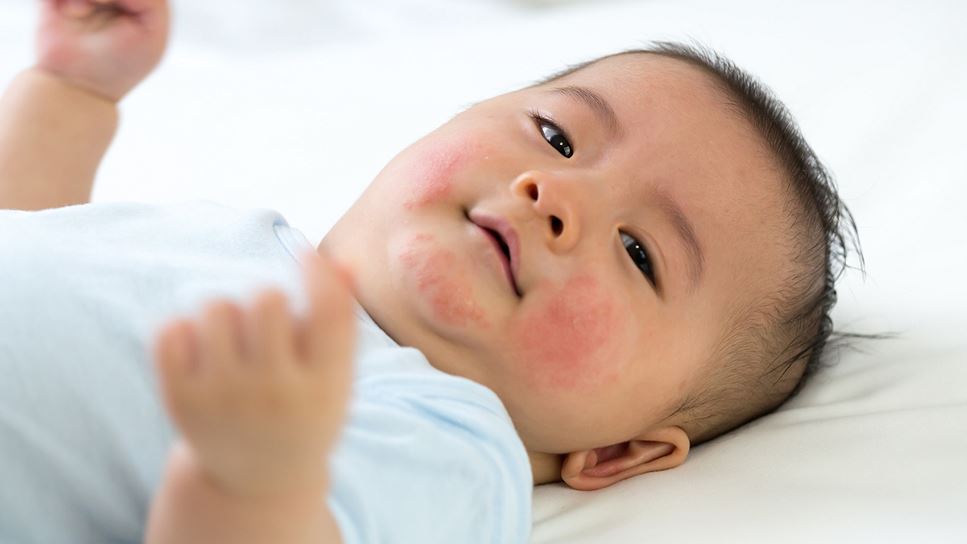 Baby with eczema is higher risk for developing a food allergy.